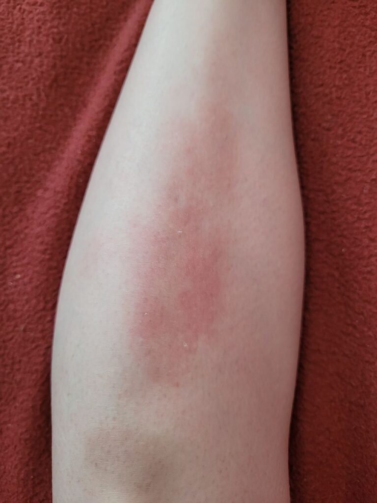 Psoriasis on shins before applying Riciniol Clary Sage. It has been a problem for years