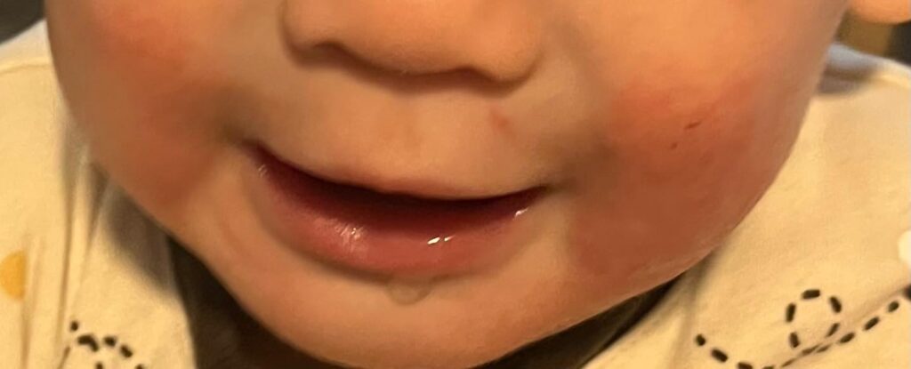 The night before applying Riciniol Baby. There's red and flaky skin on the baby's cheeks.