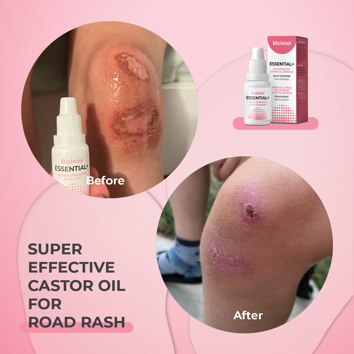 eczema psoriasis dermatitis super castor oil riciniol burns first aid care