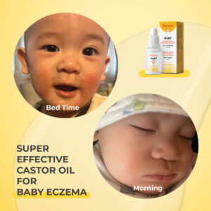 baby eczema cradle cap super castor oil riciniol