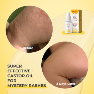 baby dermatitis eczema cradle cap super castor oil riciniol