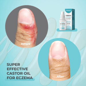 eczema psoriasis dermatitis super castor oil riciniol