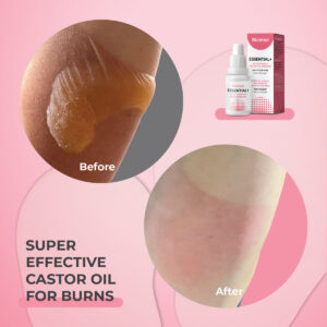 eczema psoriasis dermatitis super castor oil riciniol burns first aid care