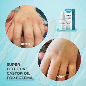 eczema psoriasis dermatitis super castor oil riciniol burns first aid care