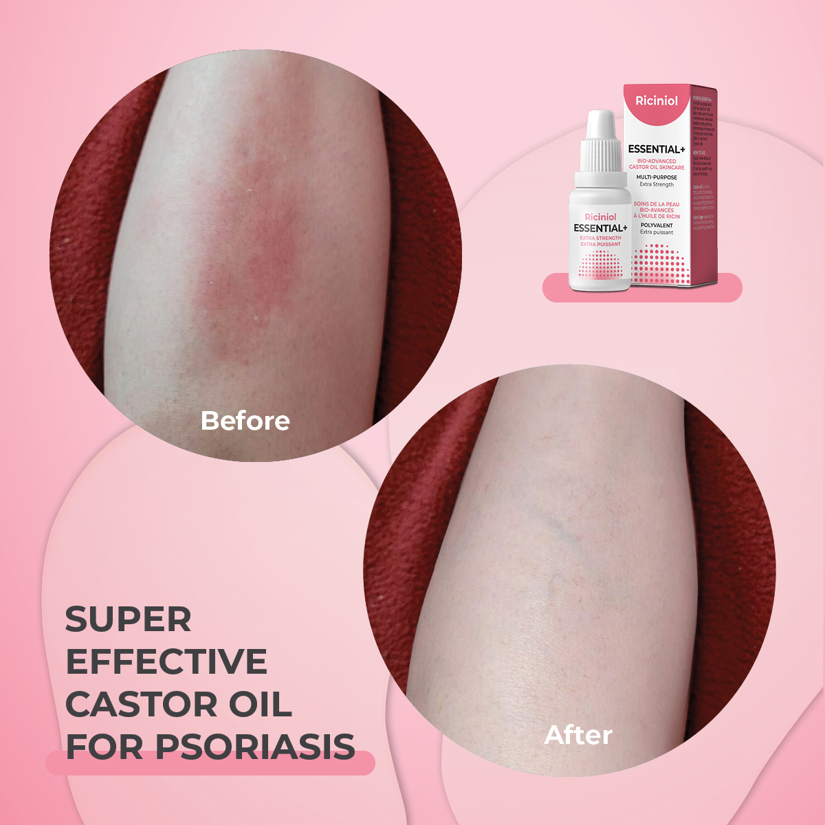 eczema psoriasis dermatitis super castor oil riciniol burns first aid care